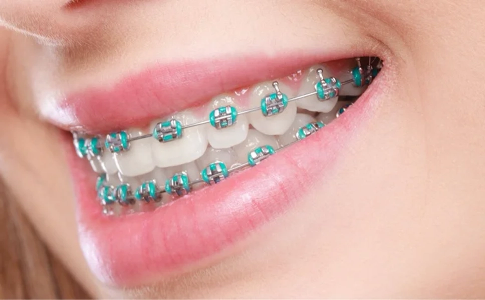 Braces ￼