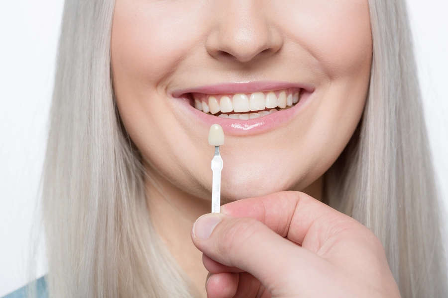veneers 