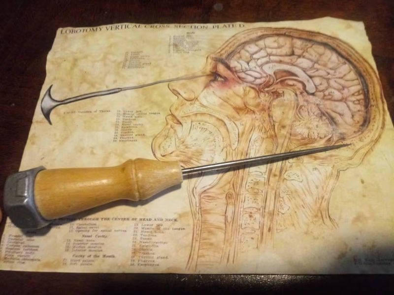 Lobotomy Chart Replica Print (8.5x11)