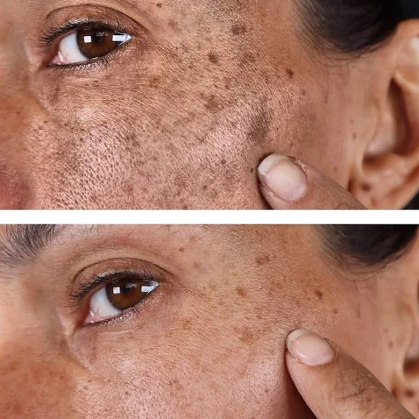 BioFormula Select Hyperpigmentation On Face Mask